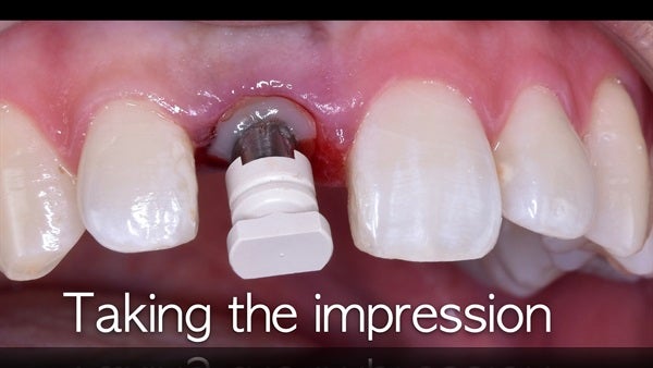 The   One-Time   Socket   Abutment Just    For   Incisor