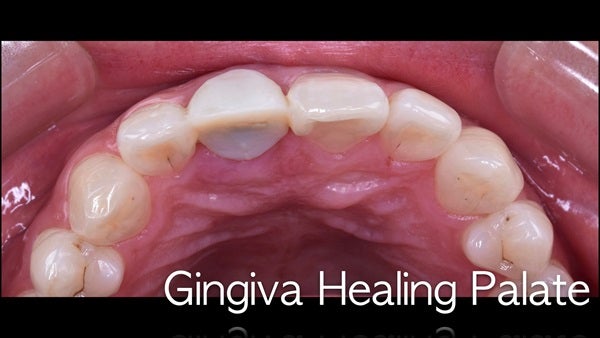 The   One-Time   Socket   Abutment Just    For   Incisor