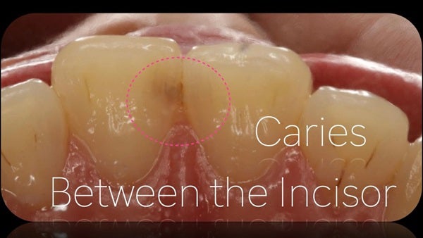The Immediately  restoration of Central Incisor  on Lingual  Surface 