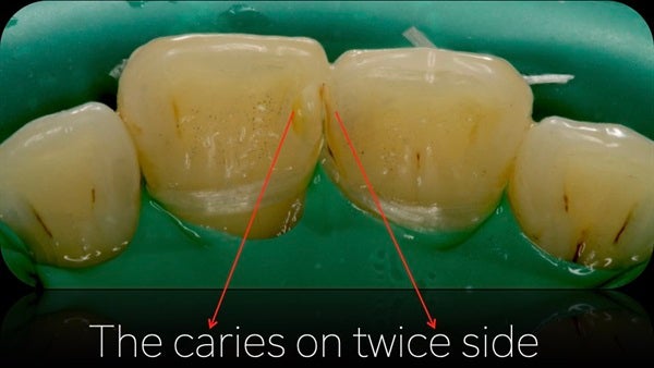 The Immediately  restoration of Central Incisor  on Lingual  Surface 