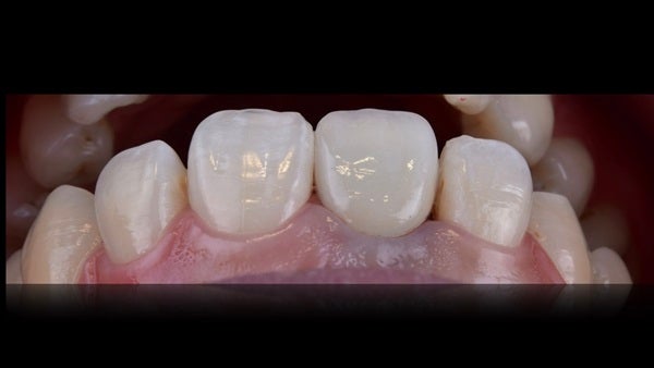 The   One-Time   Socket   Abutment Just    For   Incisor