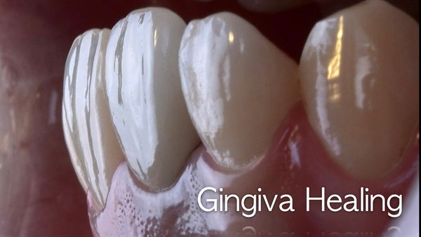 The   One-Time   Socket   Abutment Just    For   Incisor