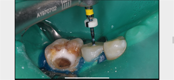 The Rct for big cyst