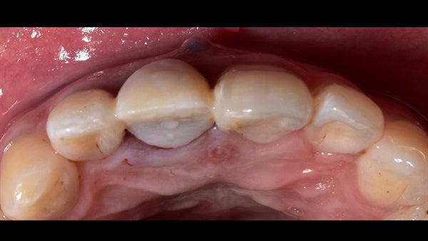 The   One-Time   Socket   Abutment Just    For   Incisor