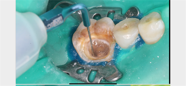 The Rct for big cyst