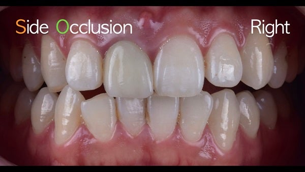 The   One-Time   Socket   Abutment Just    For   Incisor