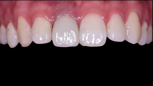 The   One-Time   Socket   Abutment Just    For   Incisor