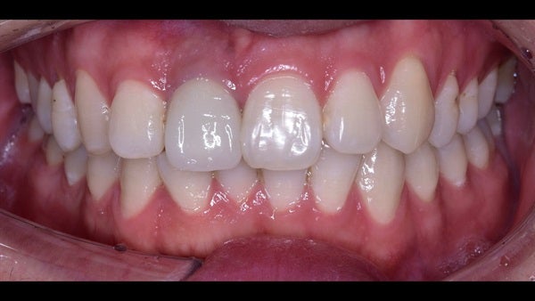 The   One-Time   Socket   Abutment Just    For   Incisor