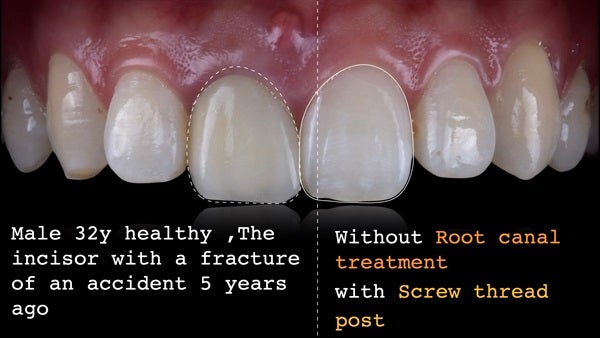 The   One-Time   Socket   Abutment Just    For   Incisor