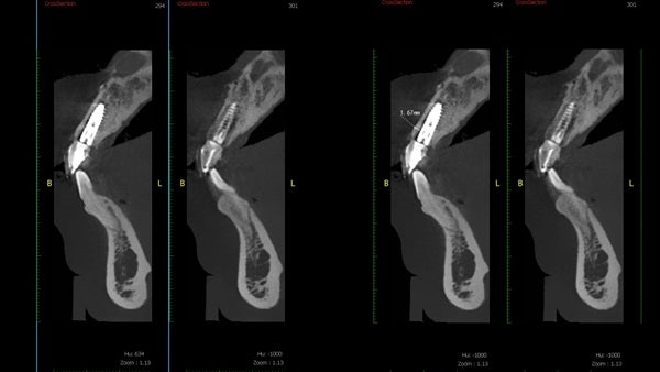 The   One-Time   Socket   Abutment Just    For   Incisor