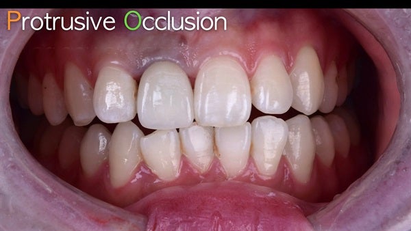The   One-Time   Socket   Abutment Just    For   Incisor