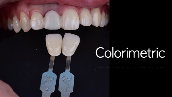 The   One-Time   Socket   Abutment Just    For   Incisor