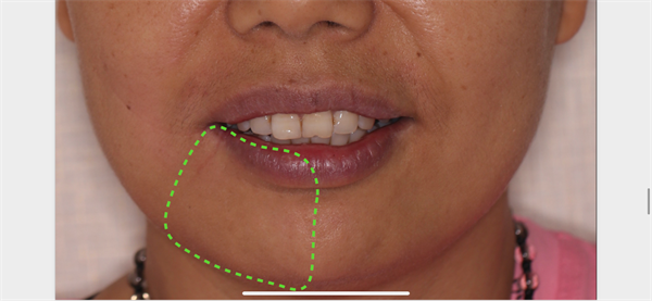 The Rct for big cyst