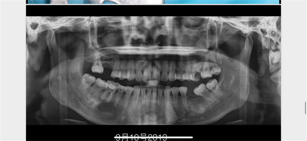 The Rct for big cyst
