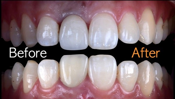 The   One-Time   Socket   Abutment Just    For   Incisor