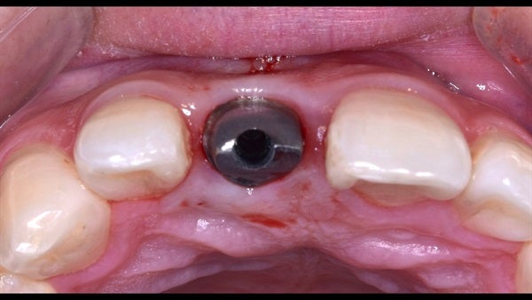 The   One-Time   Socket   Abutment Just    For   Incisor