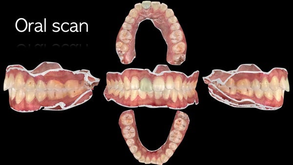 The   One-Time   Socket   Abutment Just    For   Incisor