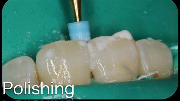 The Immediately  restoration of Central Incisor  on Lingual  Surface 