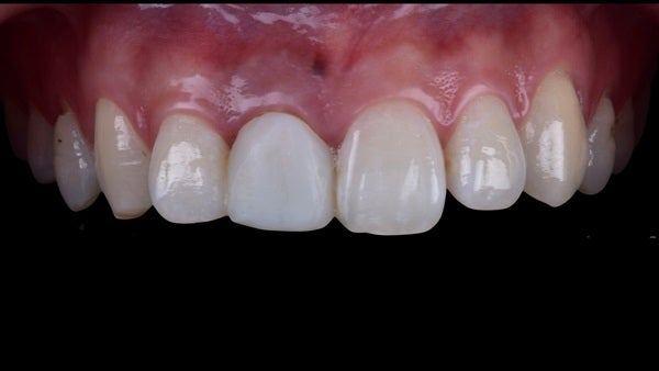 The   One-Time   Socket   Abutment Just    For   Incisor