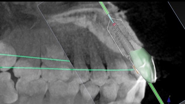 The   One-Time   Socket   Abutment Just    For   Incisor