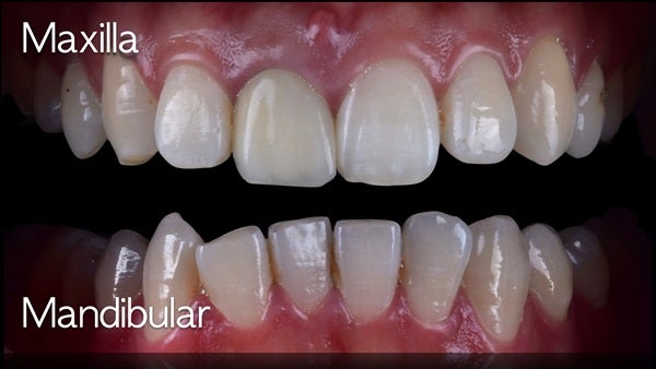 The   One-Time   Socket   Abutment Just    For   Incisor