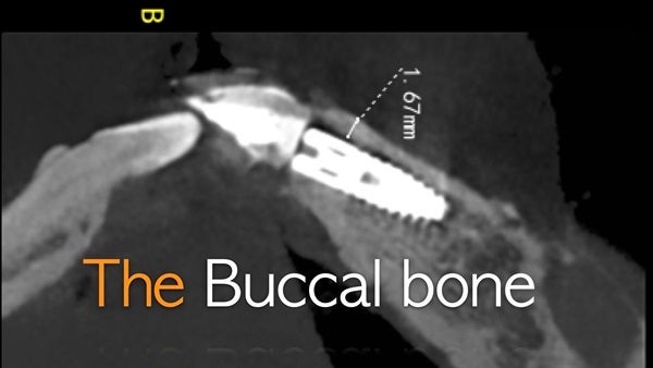 The   One-Time   Socket   Abutment Just    For   Incisor