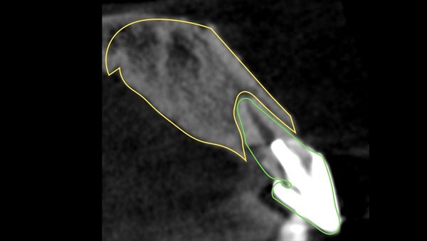The   One-Time   Socket   Abutment Just    For   Incisor