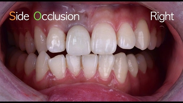 The   One-Time   Socket   Abutment Just    For   Incisor