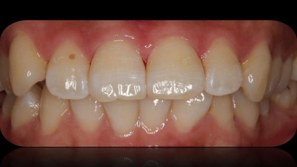 The Immediately  restoration of Central Incisor  on Lingual  Surface 