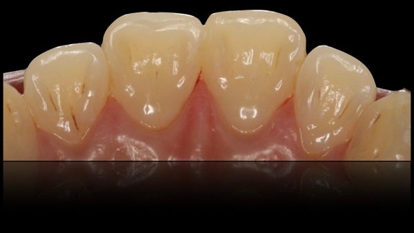 The Immediately  restoration of Central Incisor  on Lingual  Surface 