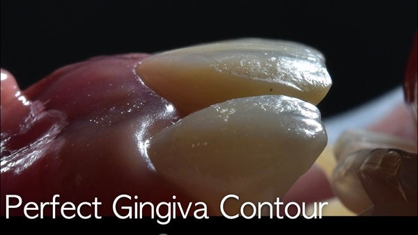 The   One-Time   Socket   Abutment Just    For   Incisor