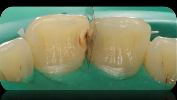 The Immediately  restoration of Central Incisor  on Lingual  Surface 