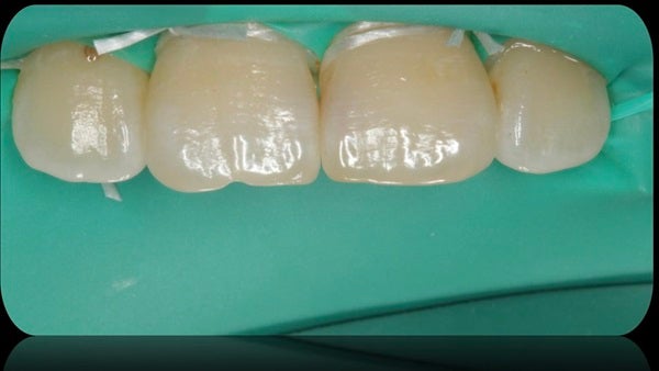 The Immediately  restoration of Central Incisor  on Lingual  Surface 