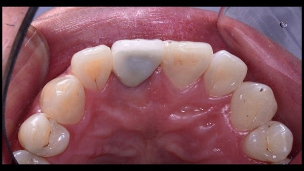 The   One-Time   Socket   Abutment Just    For   Incisor