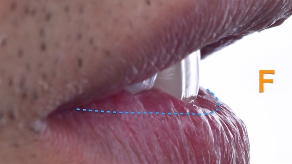 The   One-Time   Socket   Abutment Just    For   Incisor
