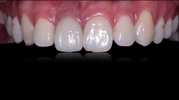 The   One-Time   Socket   Abutment Just    For   Incisor