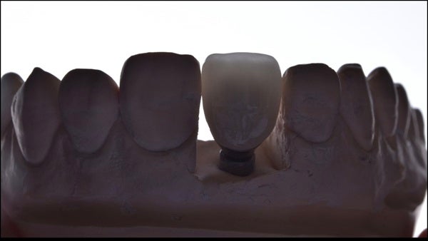The   One-Time   Socket   Abutment Just    For   Incisor