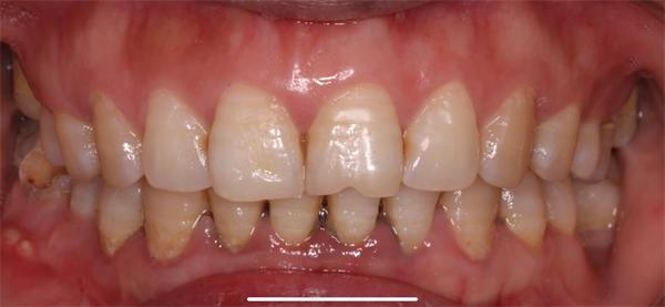 The Rct for big cyst