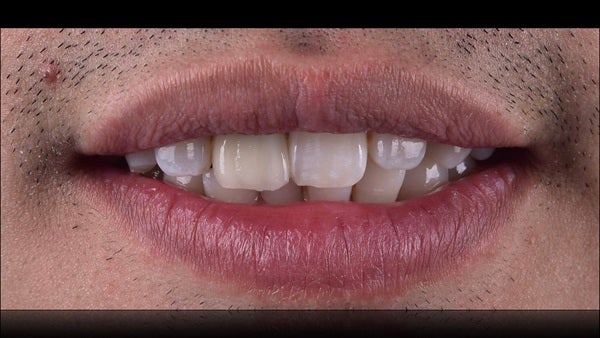 The   One-Time   Socket   Abutment Just    For   Incisor