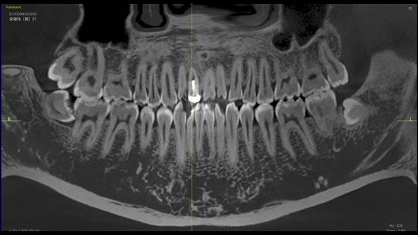 The   One-Time   Socket   Abutment Just    For   Incisor
