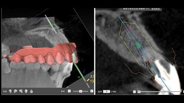 The   One-Time   Socket   Abutment Just    For   Incisor