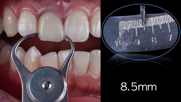 The   One-Time   Socket   Abutment Just    For   Incisor