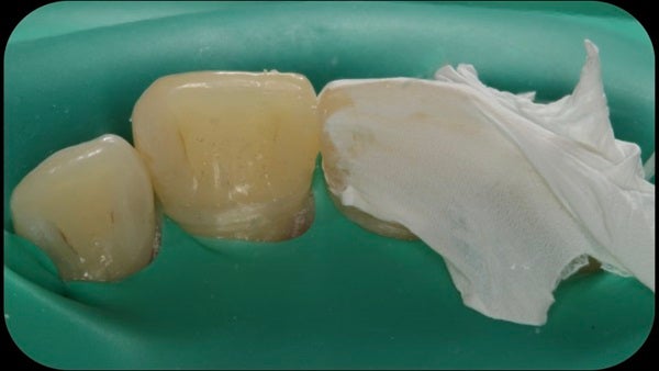 The Immediately  restoration of Central Incisor  on Lingual  Surface 