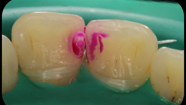 The Immediately  restoration of Central Incisor  on Lingual  Surface 