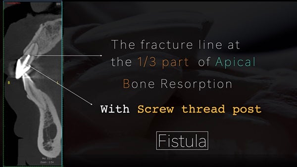 The   One-Time   Socket   Abutment Just    For   Incisor