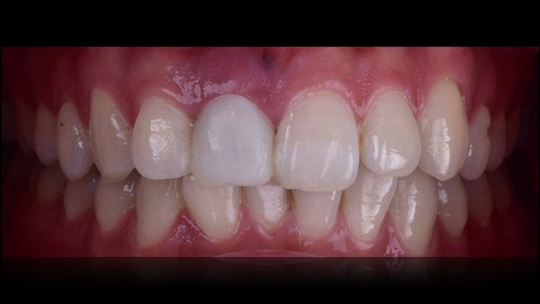 The   One-Time   Socket   Abutment Just    For   Incisor