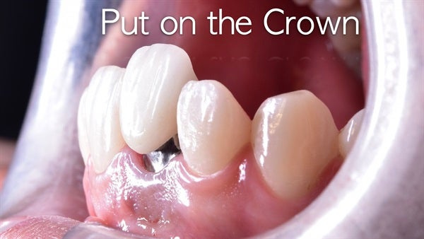 The   One-Time   Socket   Abutment Just    For   Incisor