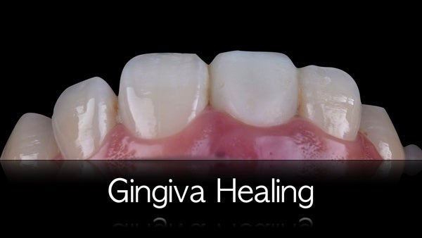 The   One-Time   Socket   Abutment Just    For   Incisor