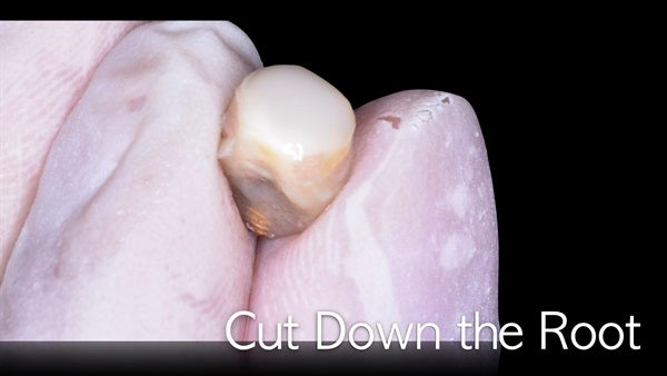 The   One-Time   Socket   Abutment Just    For   Incisor
