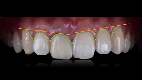 The   One-Time   Socket   Abutment Just    For   Incisor